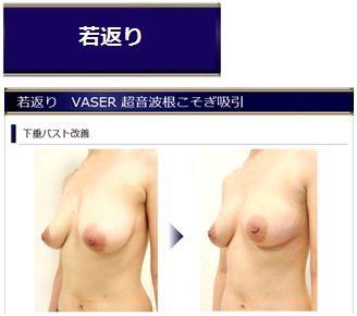 VASER脂肪吸引　若返り